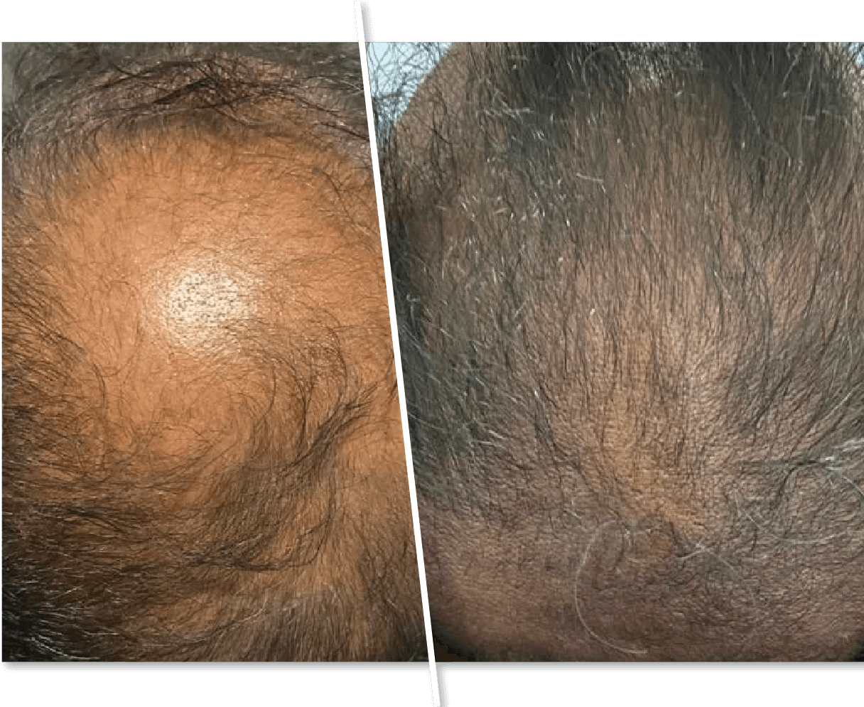 Before and After Hair Transplant